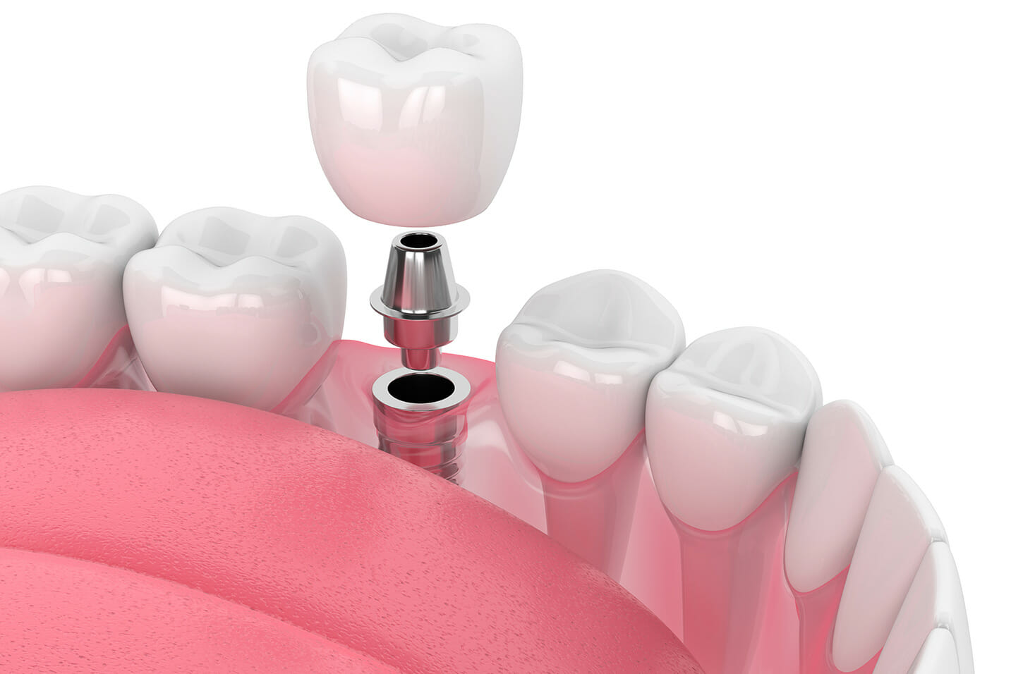 Dental Implants