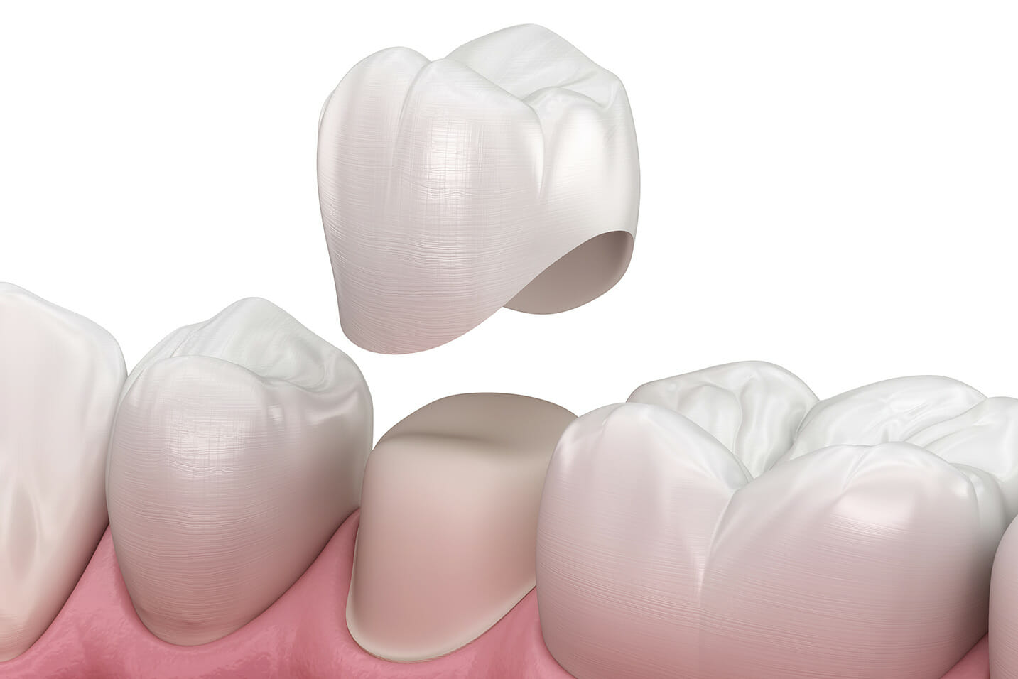 We provide Dental Crowns in Gahanna